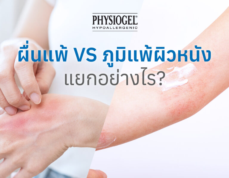 ผื่นแพ้ VS ภูมิแพ้ผิวหนัง