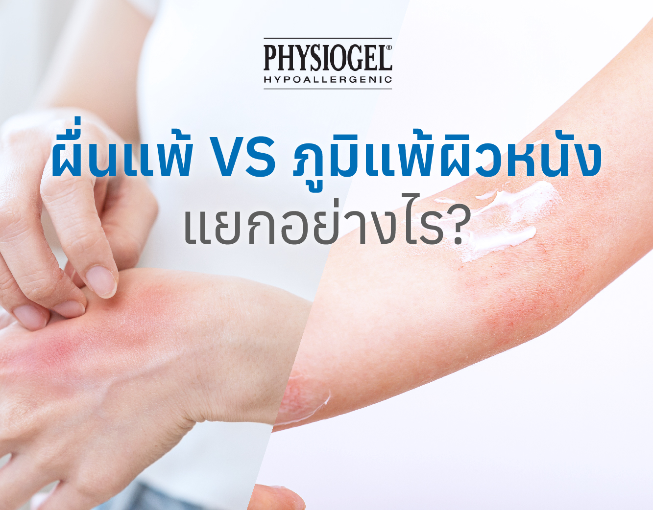 ผื่นแพ้ VS ภูมิแพ้ผิวหนัง แยกอย่างไร