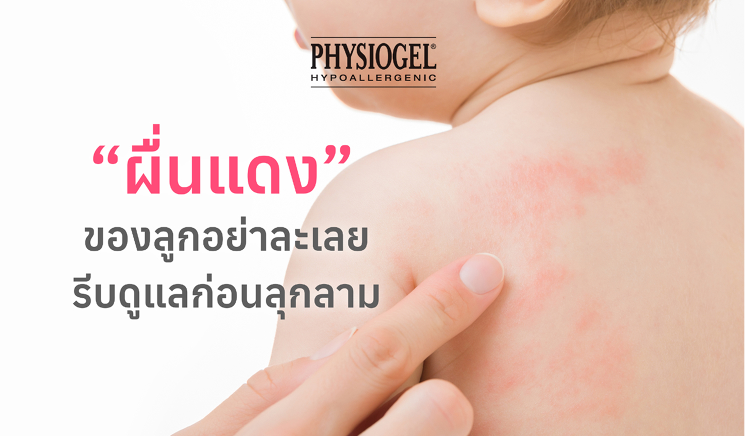 ดูแลผิวเด็กเพื่อป้องกันผื่น
